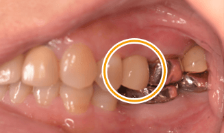 インプラントの歯（側面観）