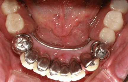 入れ歯の症例写真