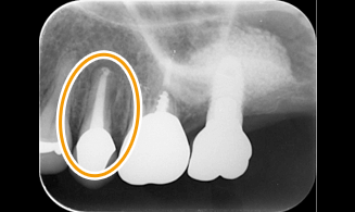 この歯の根っこが折れました。根が折れると、歯は歯周病になりウミが出ます。