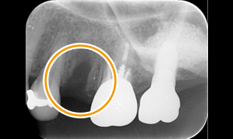 歯を抜いた後のレントゲンです。この状態で骨の治りを待ちます。