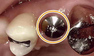 インプラント周囲の歯肉がキレイに治るためのキャップがついた状態です