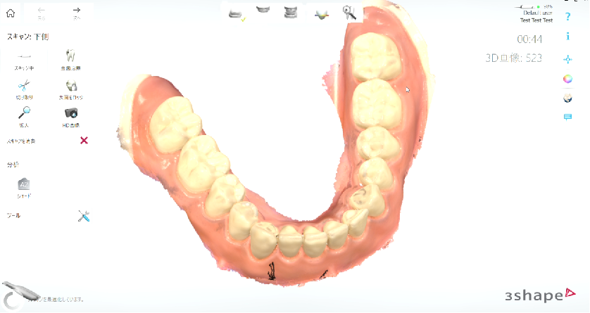 TRIOSによる口腔内scan写真